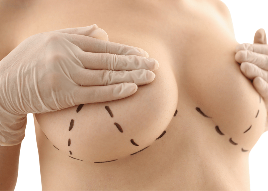 Breast Lift