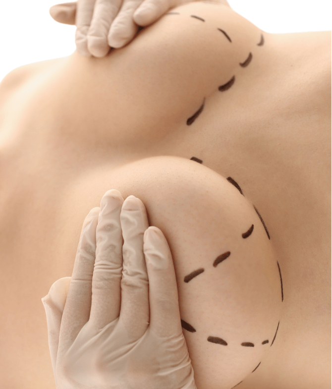 Breast Lift