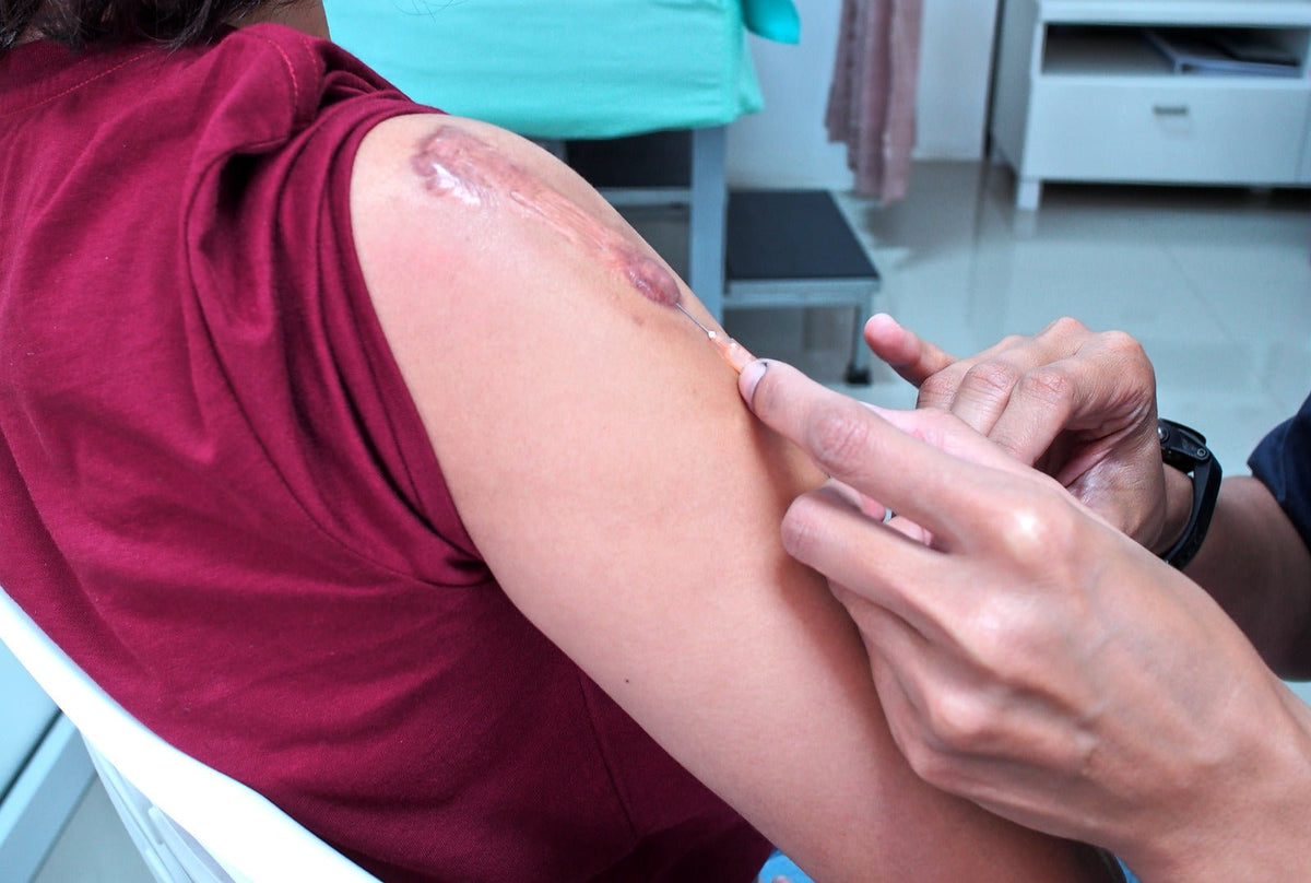 Keloid Scar Injection
