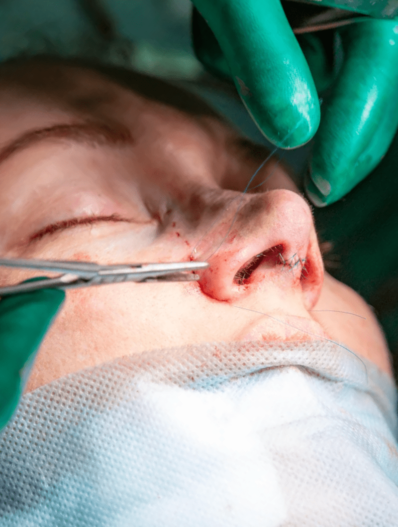 Rhinoplasty (Nose Reshaping)