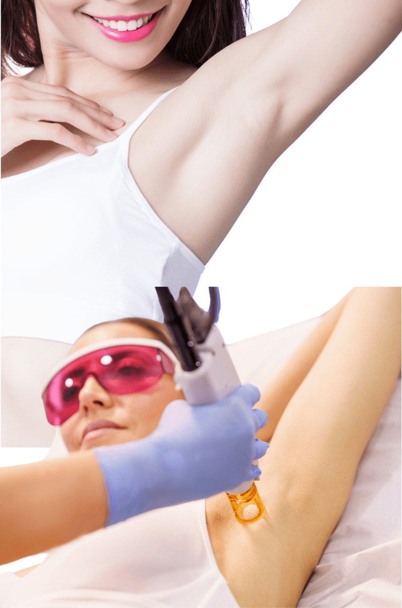 Underarm Whitening Laser