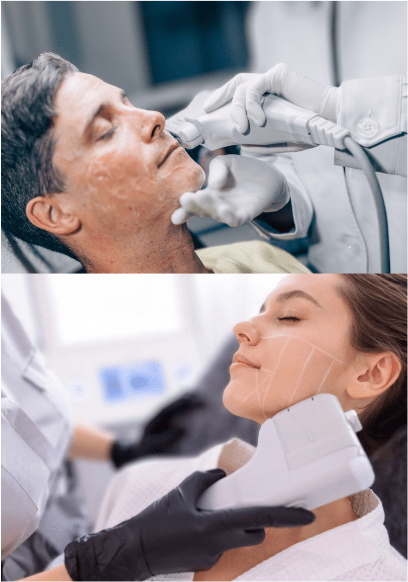 Levo Pro® (UltraLift)