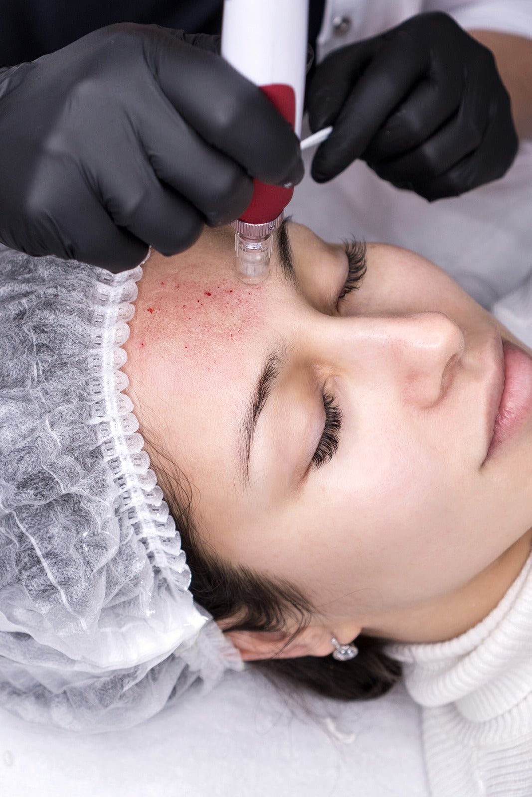 Melasma Bright