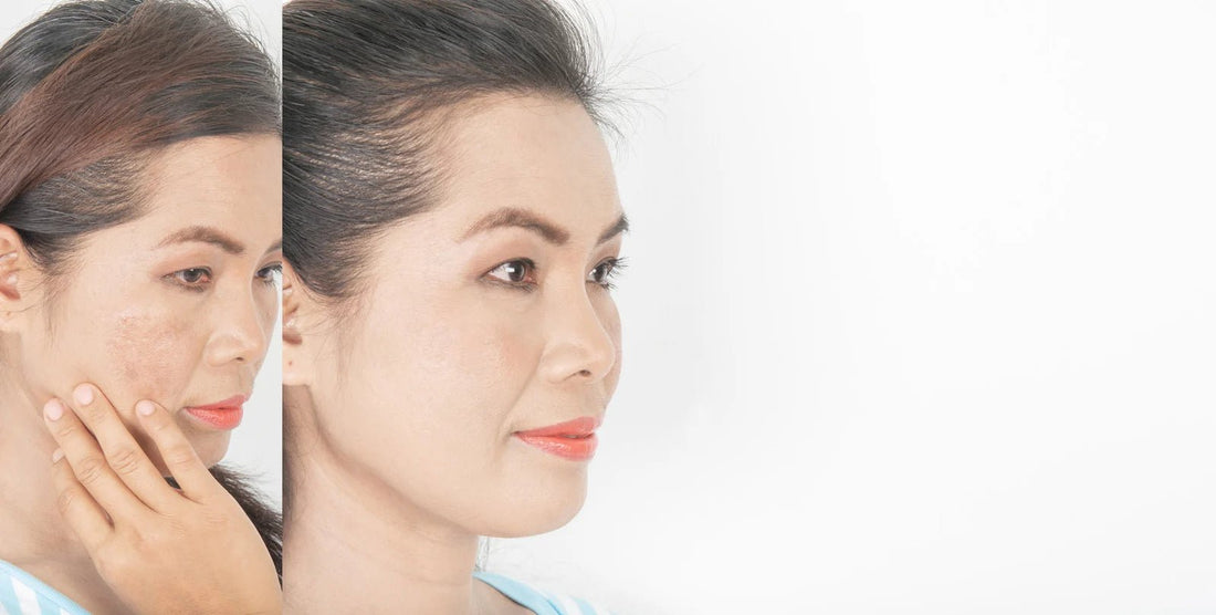 Melasma Fade Peel