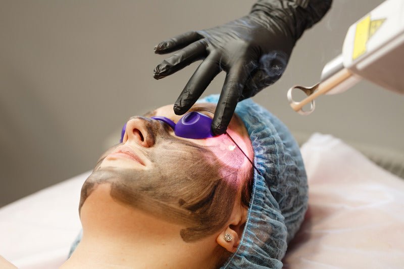 Whitening Carbon Laser Facial
